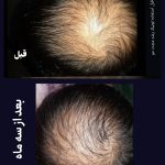 تونیک رشد مجدد موی مایانا گیاهی بدونه ماینوکسیدیل